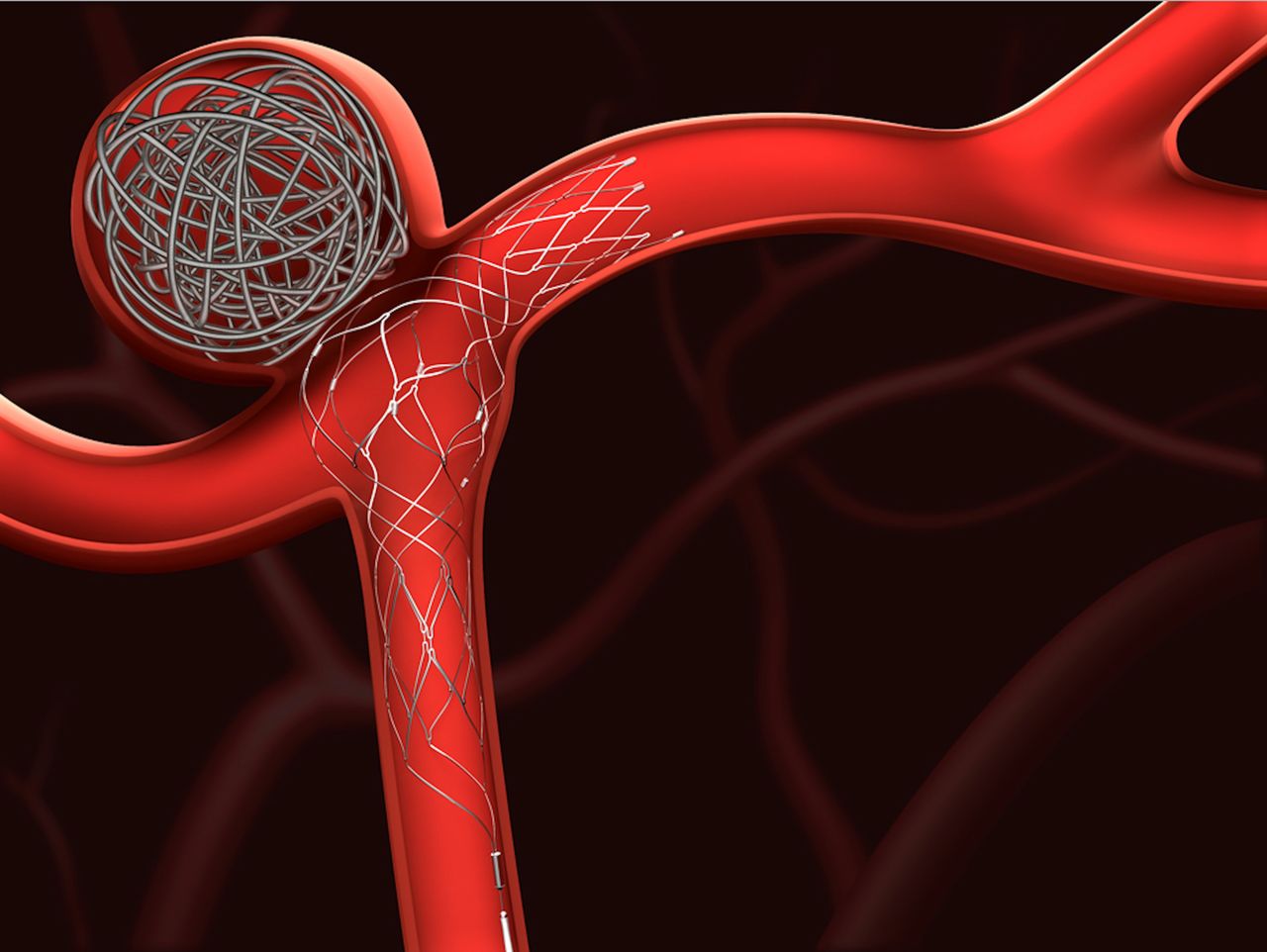 Aneurysm Brain Treatment Gandhinagar